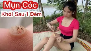 Mụn Cóc Nặng Mấy Cũng Khỏi Sau 1 Đêm Sử Dụng Cách Này, Cách Trị Mụn Cóc Siêu Nhanh Tại Nhà