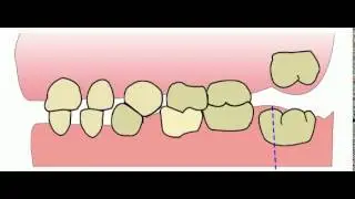 Early  Mesial Shift (Erken Mesial Shift)