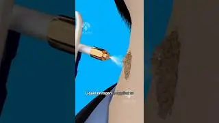 How Cryotherapy Removes Warts Safely #shorts #wartsremoval #viralvideo - Creativelearning3d