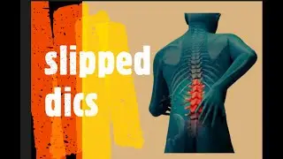 slip disc best 6 exercises, स्लिप डिस्क के लिए योग, बिना Surgery ईलाज।Back pain,Disc Bulging