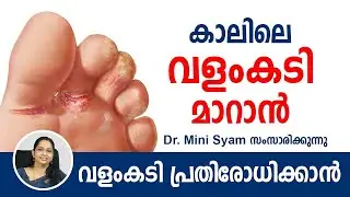 കാലിലെ വളംകടി മാറാൻ Malayalam Health Tips