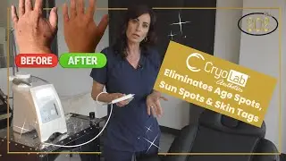 CryoLab at Dolce 202 Removes Age Spots, Sun Spots, and Skin Tags