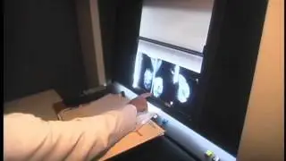 Types of Mammograms