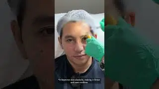Restylane Skinboosters | VJ Mendoza
