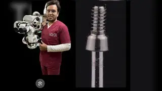 fractured screw removal from multi unit abutment 