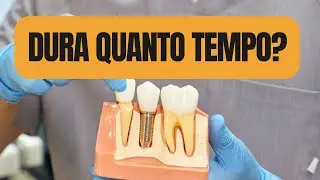 Quanto tempo dura UM IMPLANTE DENTÁRIO