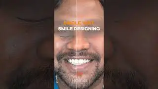 Digital Smile Designing in Single Visit | Before & After | Mohan Dental Clinic #hyderabad