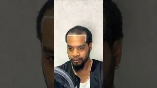 African American Hair Transplant | Afro Hair Transplant in Turkey #afrohairtransplant