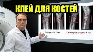 BONE-02: КИТАЙСКИЙ КЛЕЙ ДЛЯ КОСТЕЙ &mdash; КАК РАБОТАЕТ БИОАДГЕЗИВ ДЛЯ ПЕРЕЛОМОВ, ФИКСАЦИЯ ЗА 3 МИНУТЫ.