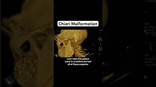 Мальформация Киари с декомпрессионной операцией и спондилодезом #chiarimalformation
