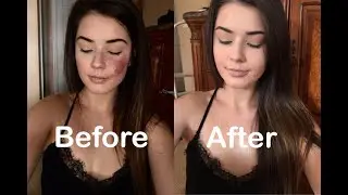 How I Cover My Port Wine Stain Birthmark