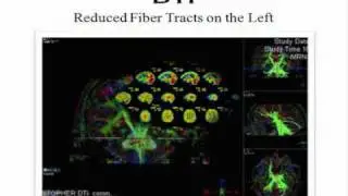 Traumatic Brain Injury - Part 6 - by Neurologist, Dr. Robert Kohn
