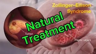 Natural Zollinger Ellison Syndrome Treatment