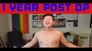 Top Surgery Results   1 Year Post Op
