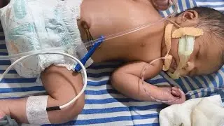 #newbornbaby Birth hypoxia high flow support 