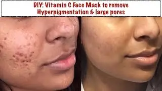 DIY Vitamin C Face Mask to Remove Hyperpigmentation & Large Pores || Get Smoother Brighter Skin