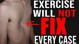 I&rsquo;ve Coached 1,000+ People With Pectus Excavatum (Here&rsquo;s What I Learned)