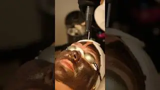 Red carpet ready with our Hollywood Laser Peel facial!