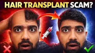 HAIR TRANSPLANT  करवाना चाहिए या नहीं।। पूरी reality exposed।। HAIR transplant truth before after