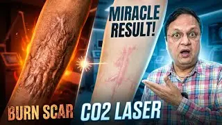 Result Burn Scar Combination Treatment | CO2 Laser Scar Removal
