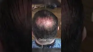 Original Toppik Hair Building Fibers in Multan Pakistan  #toppik #hairstyle #recedinghairline