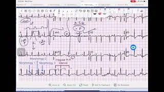 Multifocal Atrial Tachycardia vs Atrial Fibrillation | ECG & COPD Connection Explained