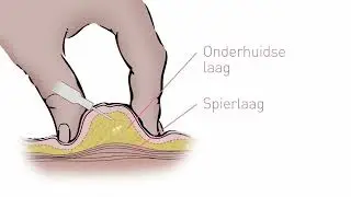 OLV Herceptin - antitumorale thuisbehandeling - instructievideo