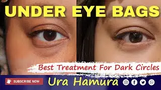 Best Surgery for Under Eye Bags and Dark Circles? Ura Hamra: Real Patient Story & Results