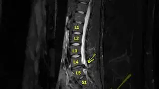 How to fix Lumbar Disc Extrusion #extrusion #sciatica #reabsorption