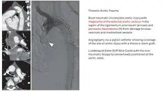 Aortic Intervention with stents, embolic agents, Onyx