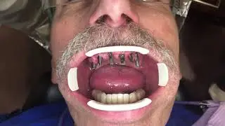Dental implant bridge dr.johnvargas dds