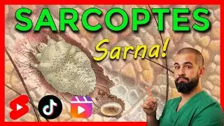 SARNA y SARCOPTES SCABIEI. Resumen en menos de 1 minuto.