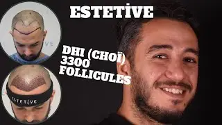 GREFFE DE CHEVEUX DHİ - AVEC LA M&Eacute;THODE DHİ -ESTETİVE - 3300 FOLLİCULES. AVANT ET APR&Egrave;S.