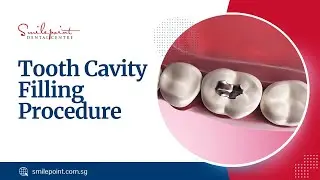 Tooth cavity filling procedure | Smilepoint Dental Centre Singapore, Holland village