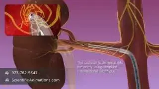 Renal Denervation - Investigational Therapy by Medtronic