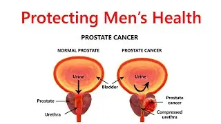 Protecting Men's Health - Prostate Cancer