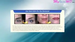 Nevi-Skin Review - How To Remove Warts And Moles By Using Nevi-Skin Free Trial