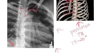 RAO sternum