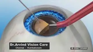 Cataract Treatment by Dr  Arvind Vision Care Eye Hospital