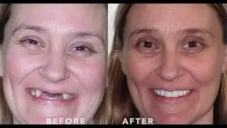 Teeth Now Buffalo vs Over-denture