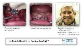 Dentatus Implant Video