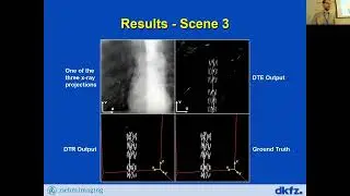 3D Reconstruction of Stents and Guidewires in an Anthropomorphic Phantom From 3 X-Ray Projections