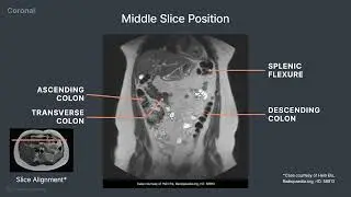 MRI Cross Sectional Anatomy of the Abdomen (Coronal View)