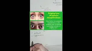Hyperthyroidism vs Hypothyroidism | antithyroid drugs | PTU & L- Thyroxine