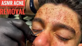 ACNE REMOVAL &bull; ASMR SLEEP HEAD MASSAGE &bull; TOO MANY ACNE