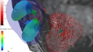 Simulation of ring-shaped vortex to transport blood flow in the human heart