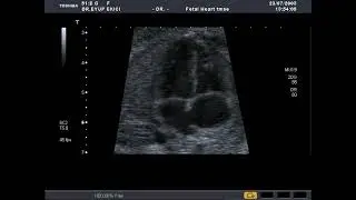 TOSHIBA APLIO-80 (2003) APICAL 4 CHAMBER  #(FETAL ECHOCARDİOGRAPHY)
