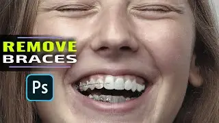 The Best Technique to Remove Braces in Photoshop