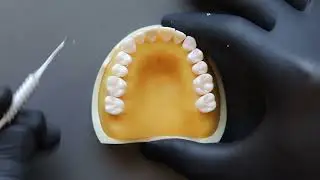 Temporizing Partial Coverage Restorations