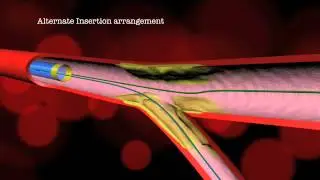 Dedicated Bifurcation Stenting and Alternative Deployment